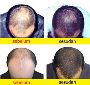 testimonial kirkland minoxidil