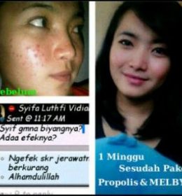 melia-biyang-untuk-jerawat